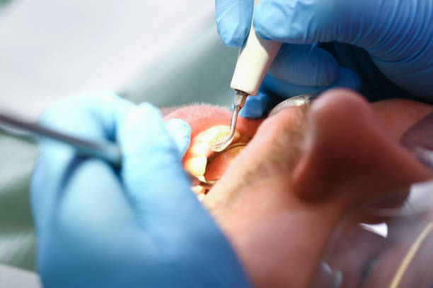 Best Emergency Dental Care for Abscessed Tooth in Fredericktown, MO