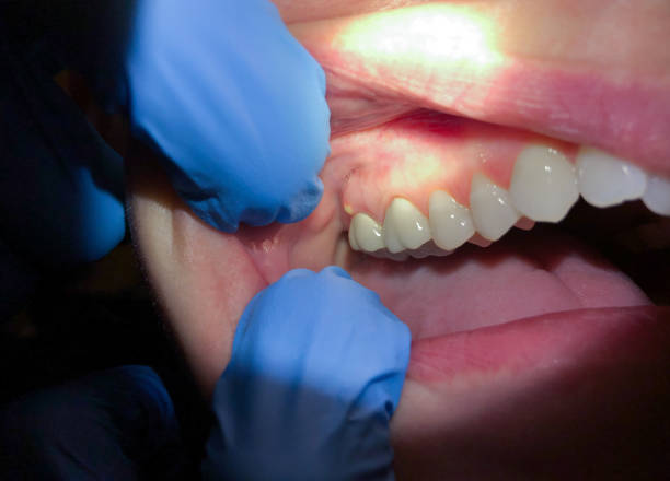 Best Emergency Dentist for Knocked-Out Tooth in Fredericktown, MO