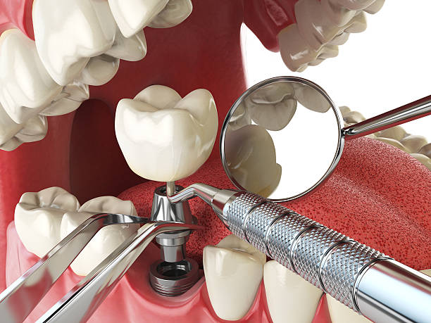 Best Emergency Dentist for Lost Fillings or Crowns in Fredericktown, MO